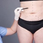 Как делают липосакцию