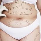 Вредна ли липосакция живота